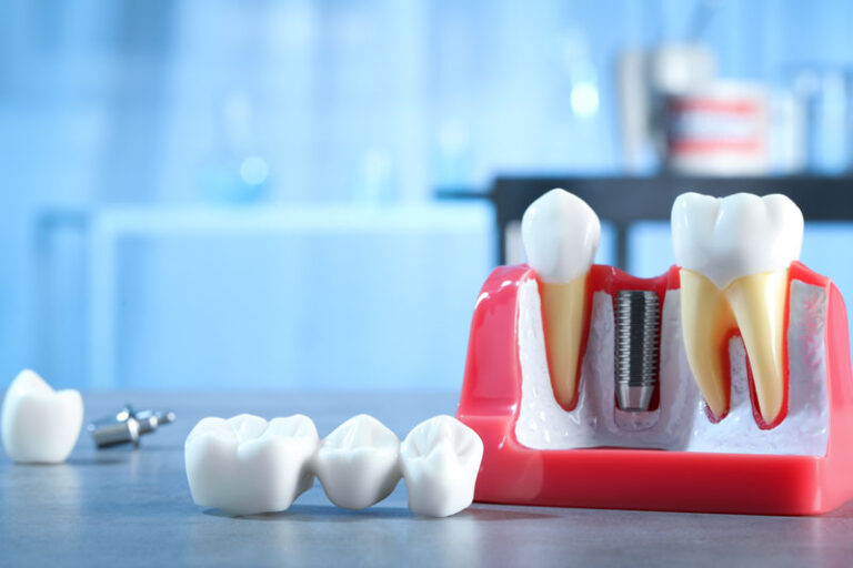 The image features a dental model with teeth, including dental implants in the jaw section, alongside extracted teeth. It is likely used for educational purposes in dental clinics or schools.