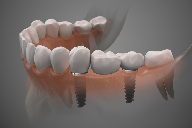 2 single dental implants with crowns on top of the implants