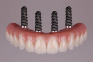 all on 4 dental implants with a full arch of teeth attached to the implants