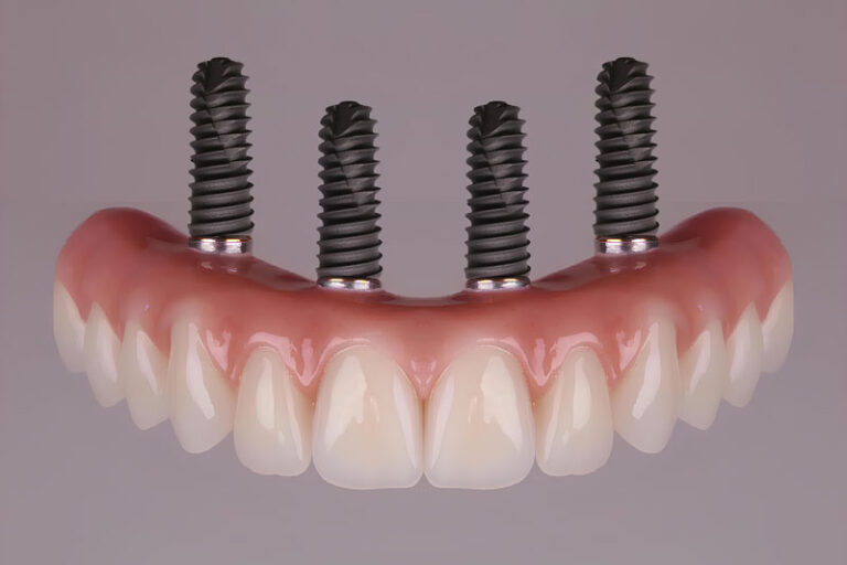 all on 4 dental implants with a full arch of teeth attached to the implants