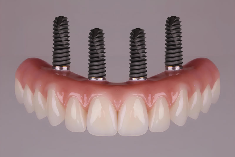 all on 4 dental implants with a full arch of teeth attached to the implants