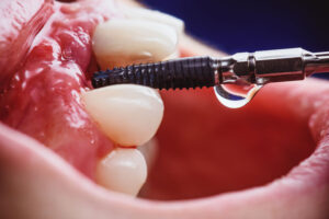 a single dental implant getting drilled into the mouth