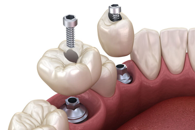 2 single dental implants with a crown on top of each of them