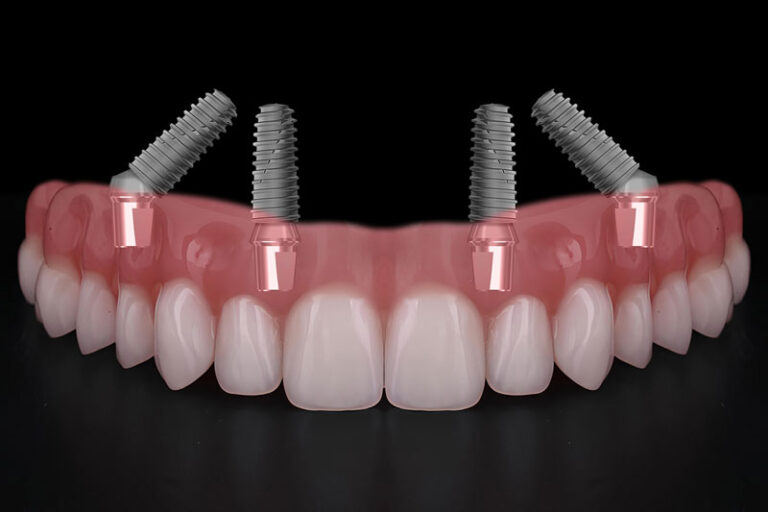 all on 4 dental implants with a full arch of teeth going across it