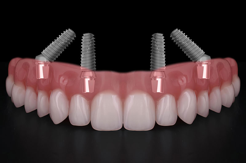 all on 4 dental implants with a full arch of teeth going across it