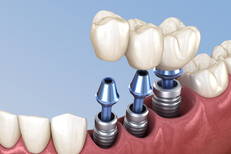 3D illustration of three single dental implants with abutments and crowns being placed in the lower jaw for tooth replacement.