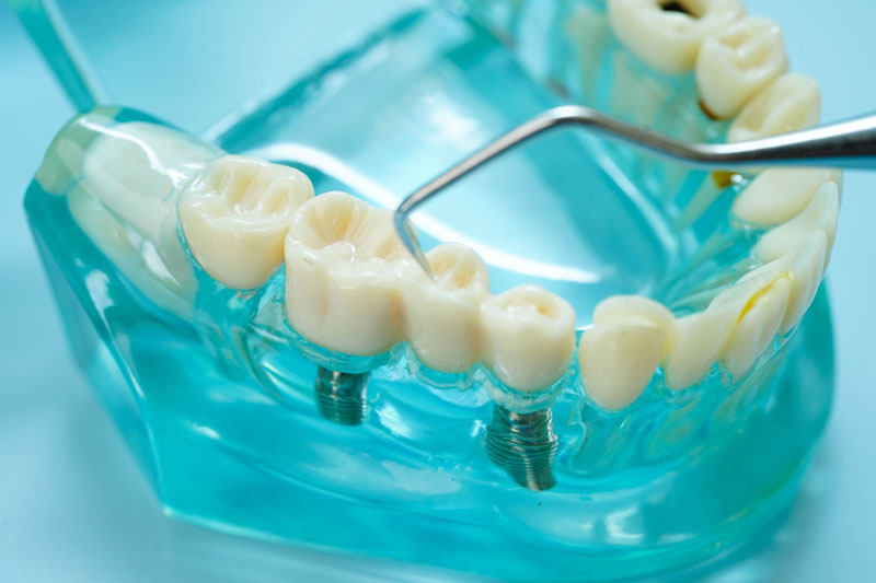 a clear dental jaw with two implants placed into the jaw