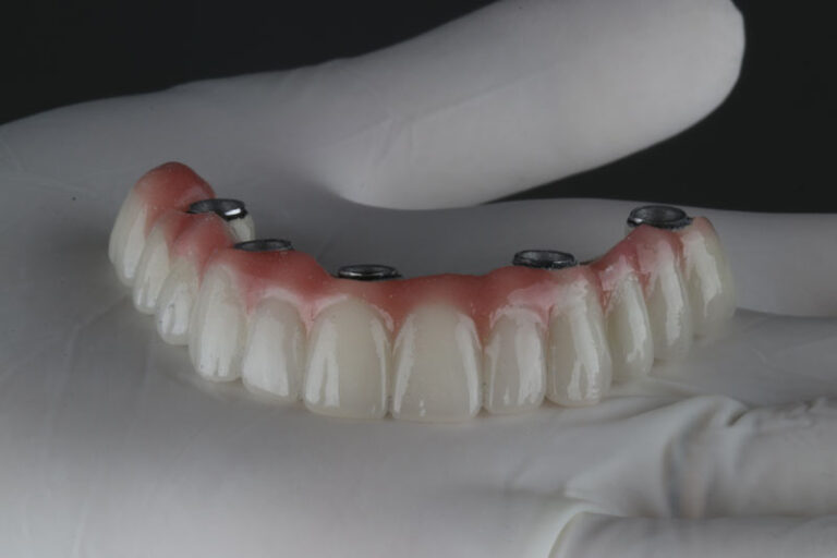 a full arch of teeth with holes for implants to be placed into it