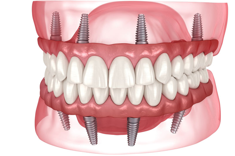 3D illustration of All-on-X dental implants showing full arch implant-supported dentures secured to the upper and lower jaws.