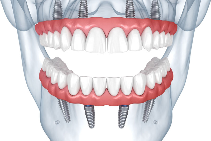 3D illustration of full mouth dental implants with implant-supported dentures attached to the upper and lower jaws."