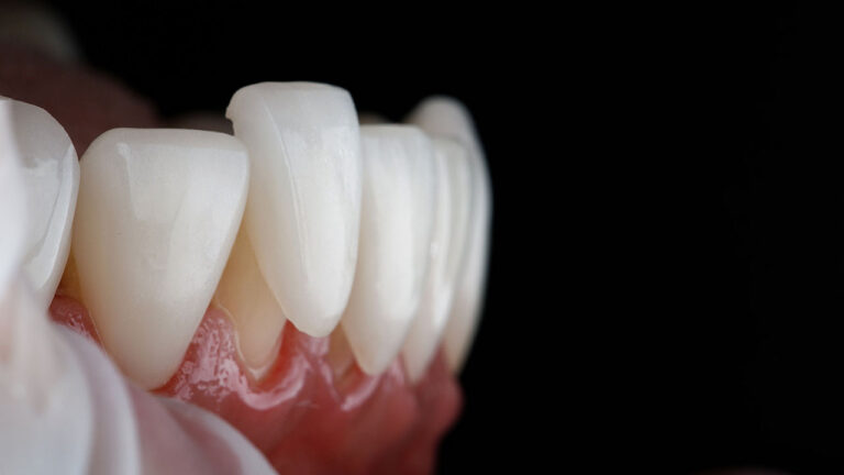 Porcelain Veneers In Sherwood, OR: A Confident Smile, One Custom Shell At A Time