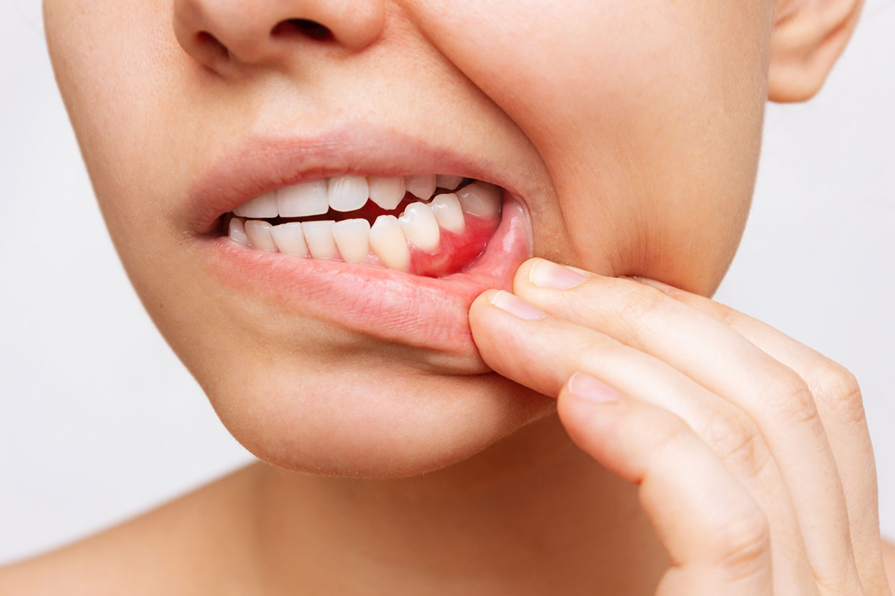 Gum Disease Treatment: How To Stop Bleeding Gums And Protect Your Smile Long-Term