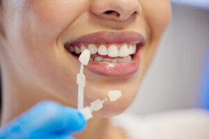 Dental Veneers: A Bright, Balanced Smile With Minimal Tooth Change