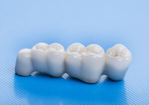 Dental Bridges in Sherwood, OR: A Fixed Solution for Missing Teeth
